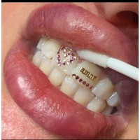 Teeth treatment in wandegeya 